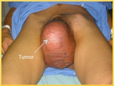 Tumor testicular derecho