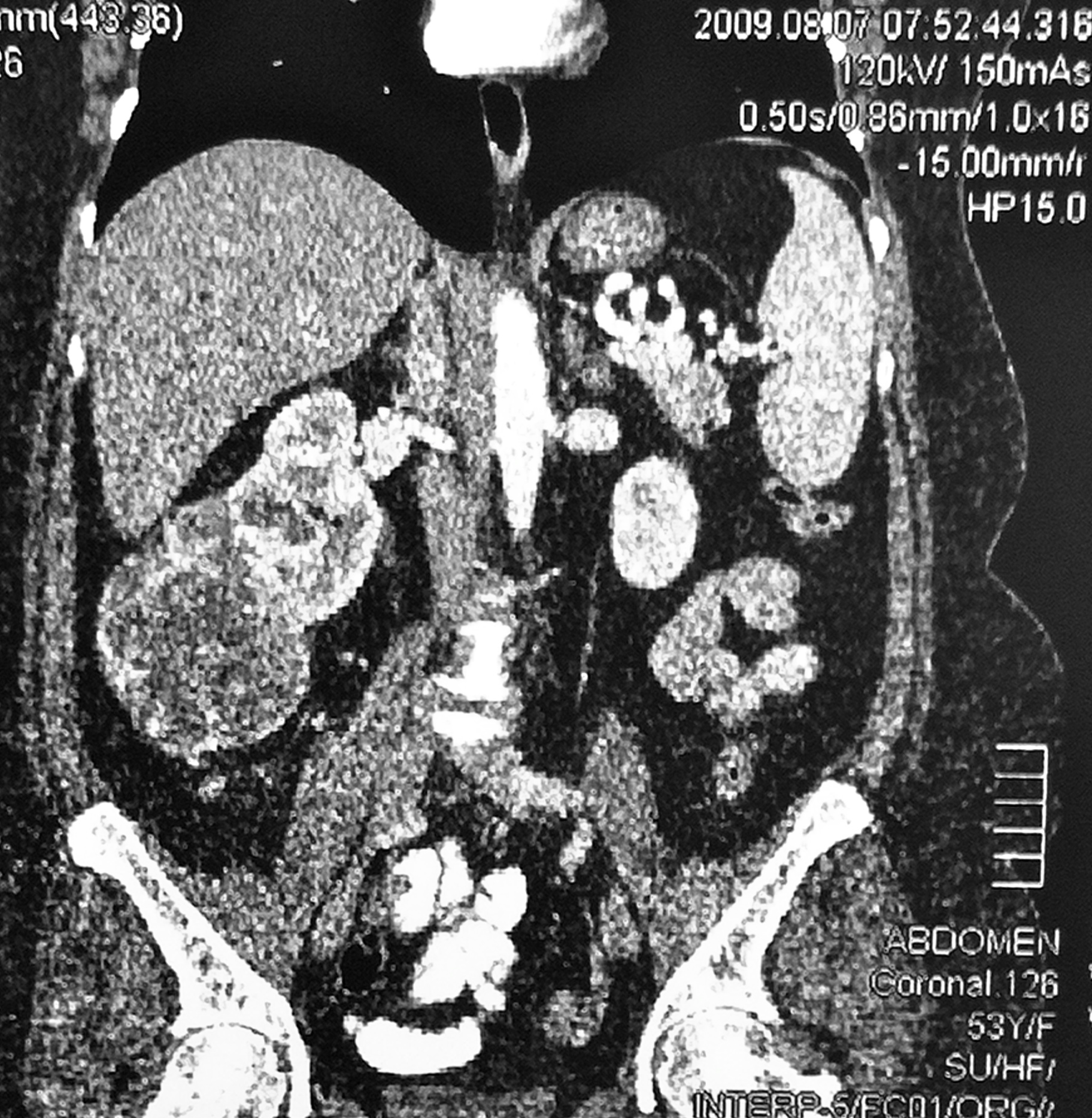 Tumor renal derecho