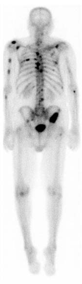 Gamagrama óseo con metástasis múltiples por cáncer de próstata
