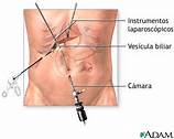 Colocación de puertos de laparoscopía