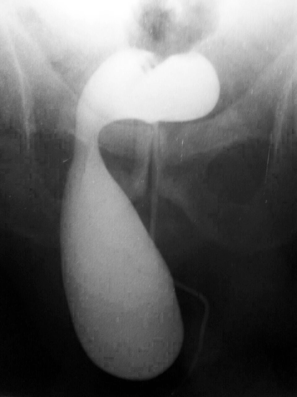 Hernia inguinal por deslizamiento, conteniendo vejiga, identificada en uretrocistografía