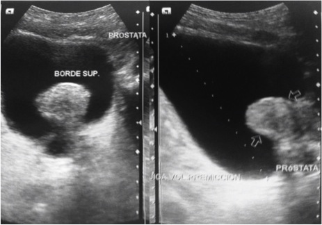 Próstata obstructiva mayor a 40cc, con lóbulo medio prominente