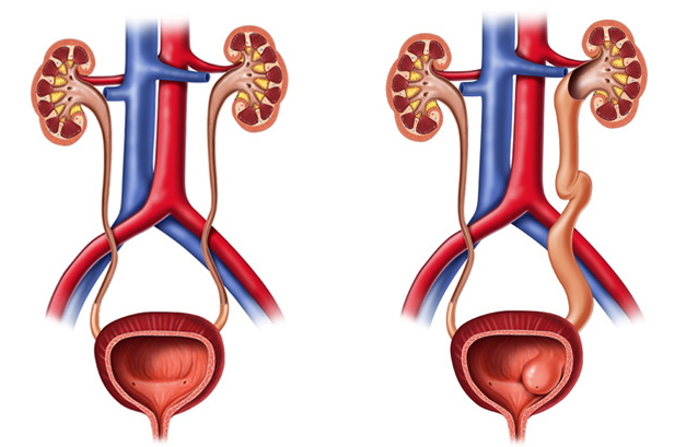 Sistema urinario normal a la izquierda y sistema urinario con ureterocele  y dilatación uréter y riñón en esquema del lado derecho